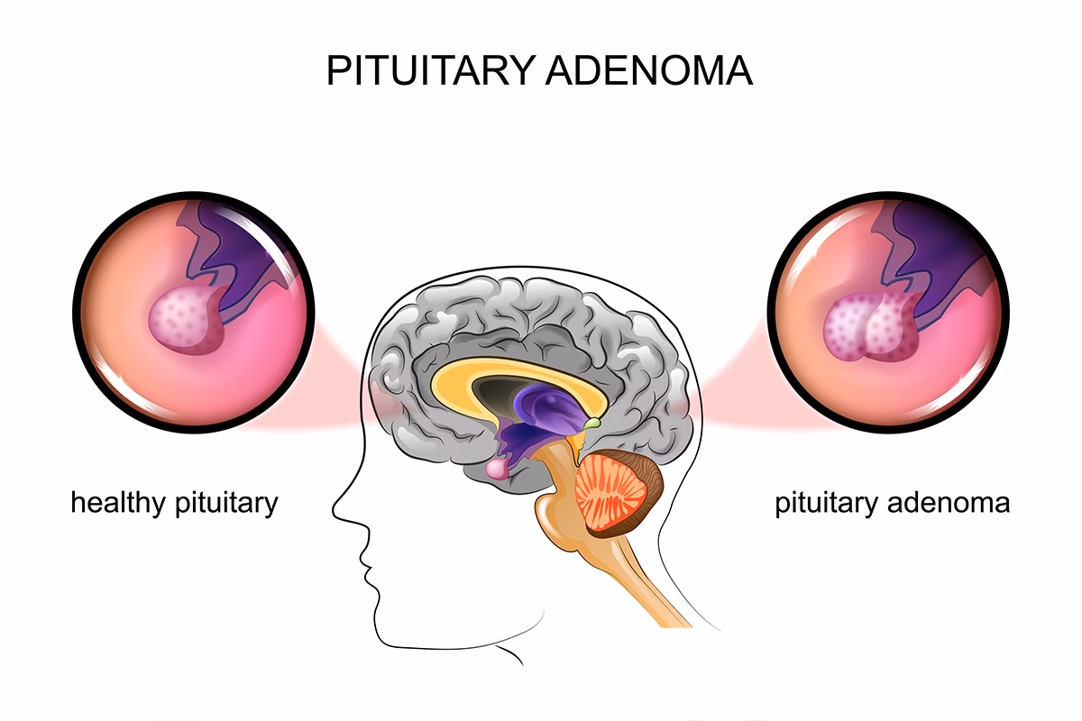 What is an adenoma in the brain?