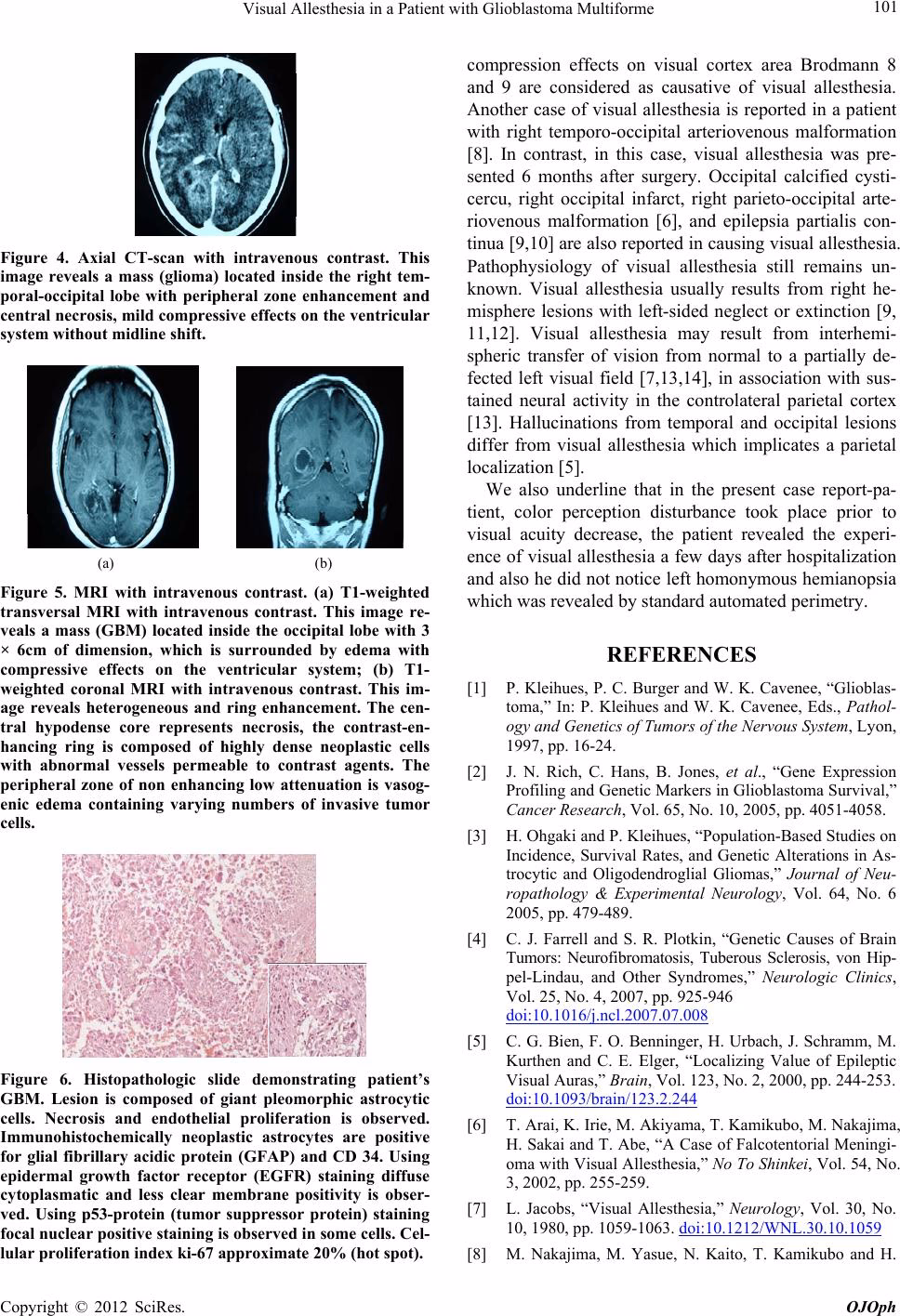What is an example of allesthesia?