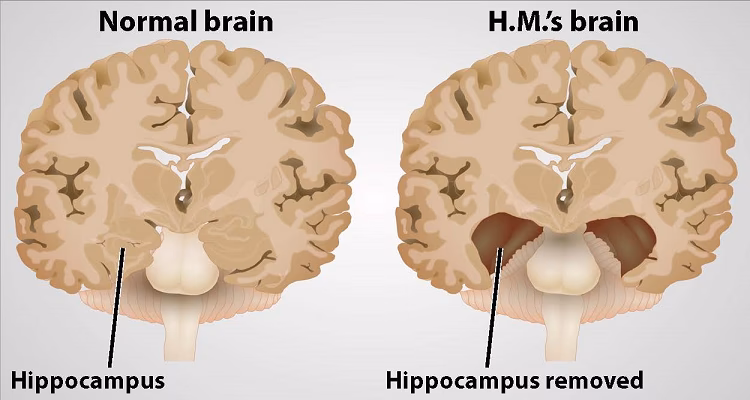 What part of the brain is involved in anterograde amnesia?