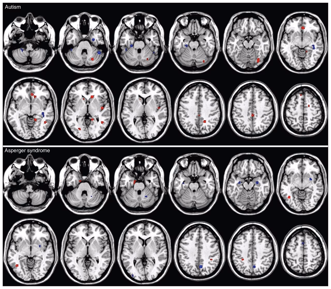 Is Asperger's syndrome neurological?