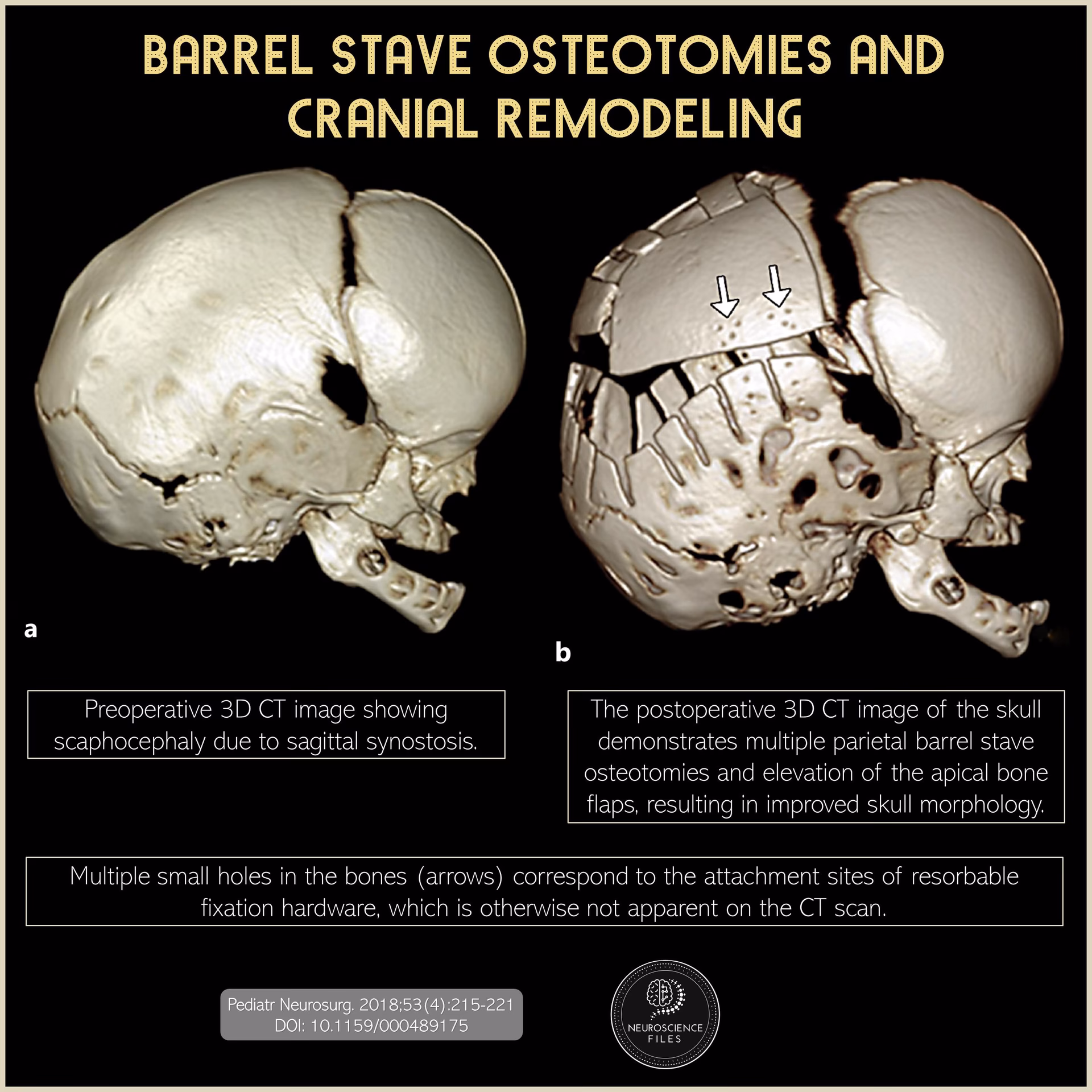 What is the barrel stave mechanism?