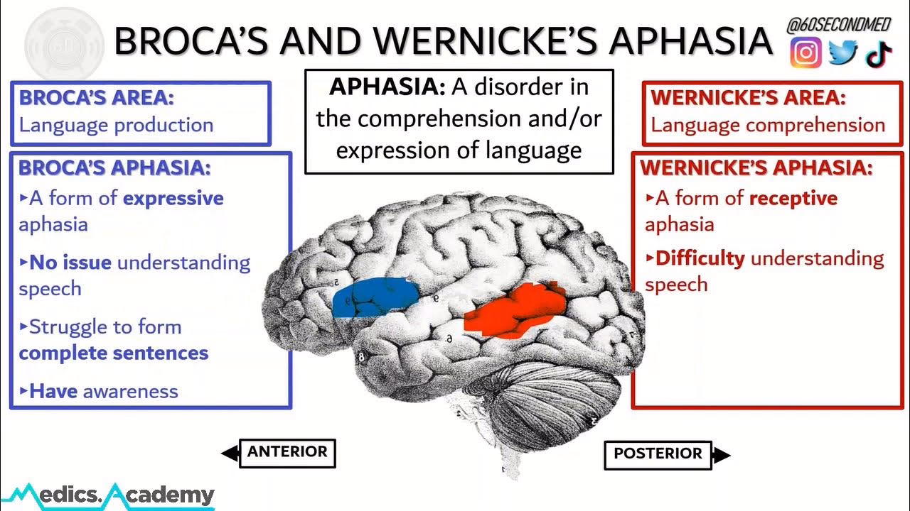 What is Broca's aphasia in simple terms?