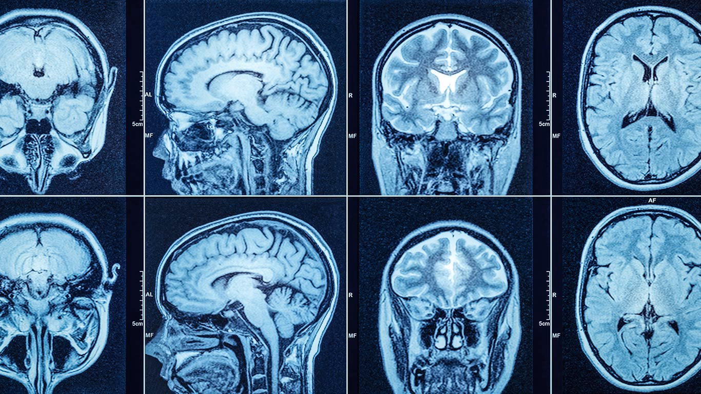 What are CT scans used for in the brain?