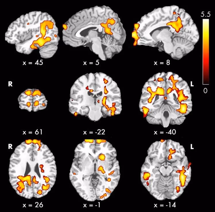 What is CBF in neuro?
