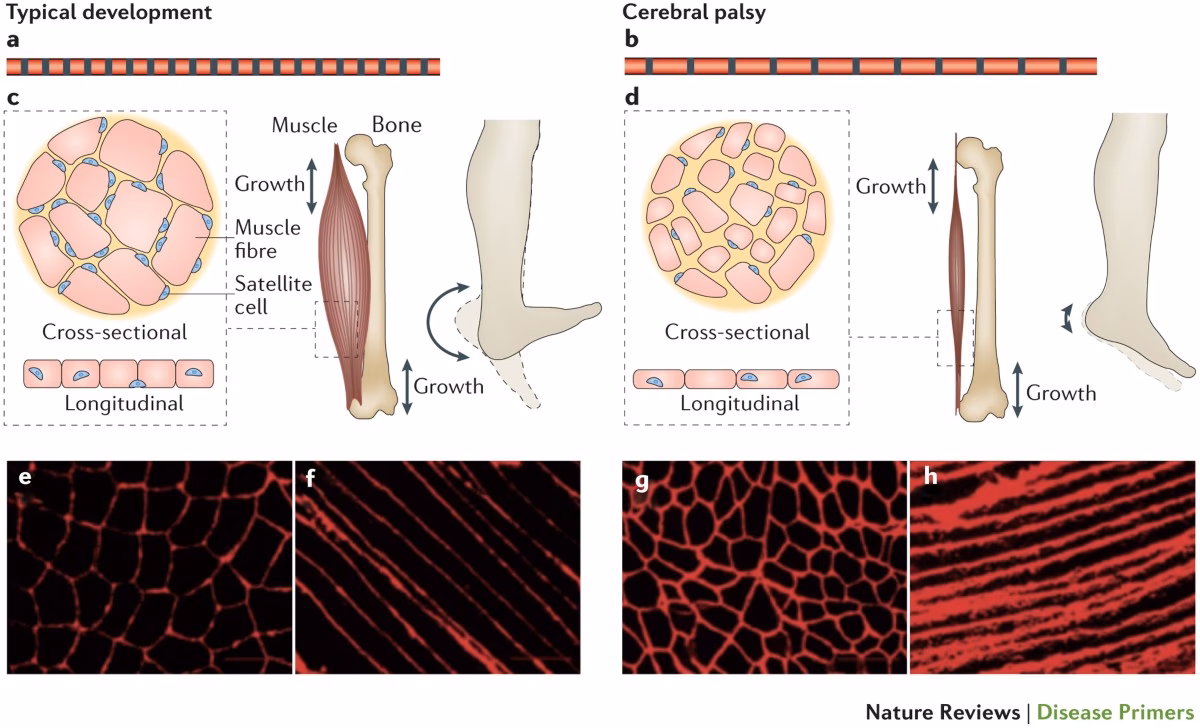 Is cerebral palsy a neurodisability?