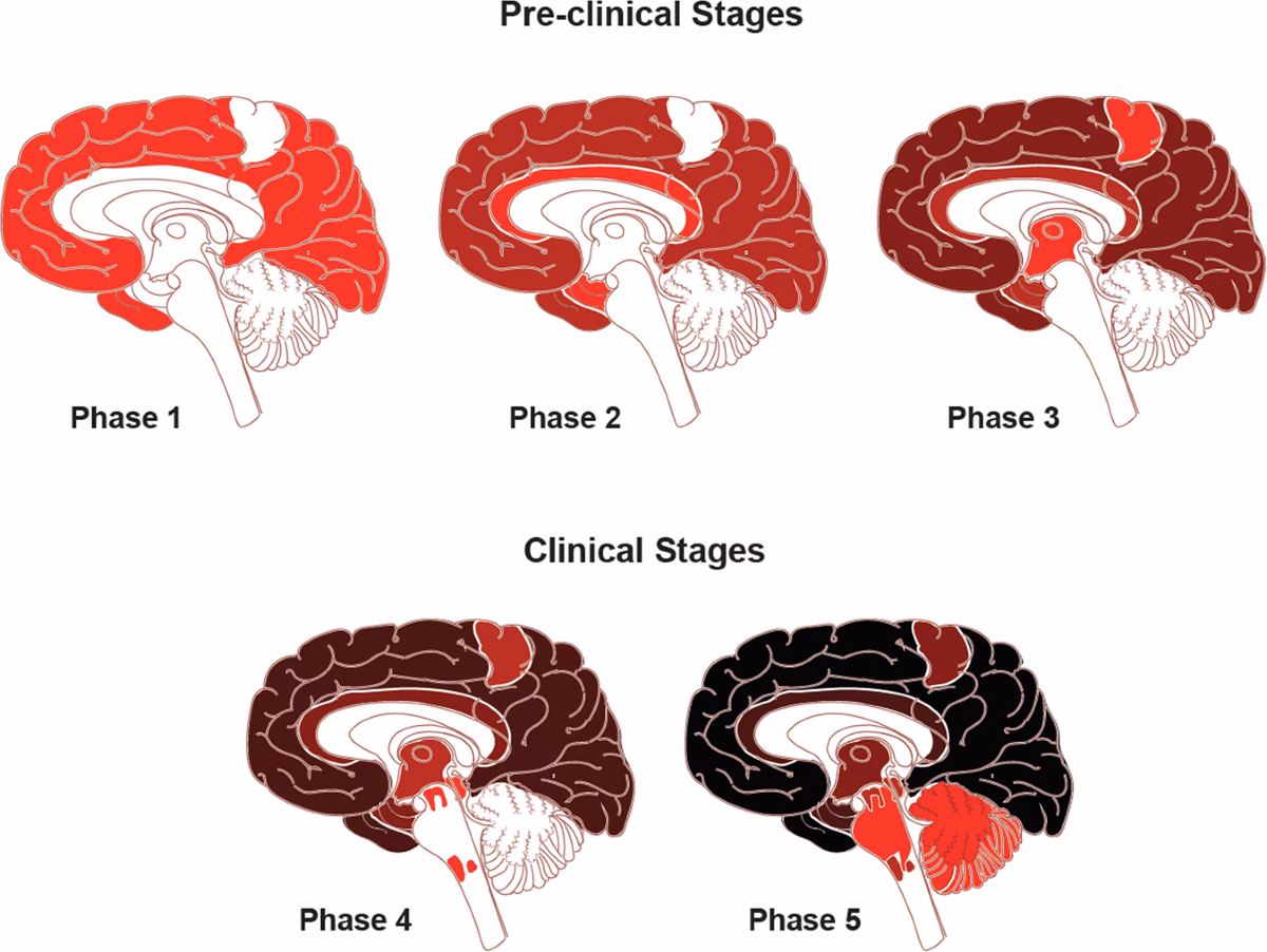 What chemical imbalance causes Alzheimer's?