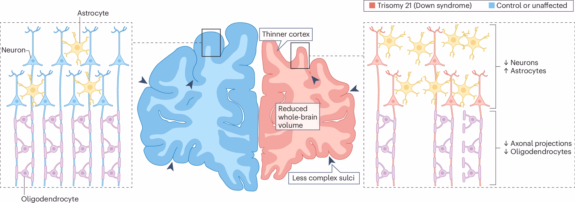 What is Down syndrome cognitive development?
