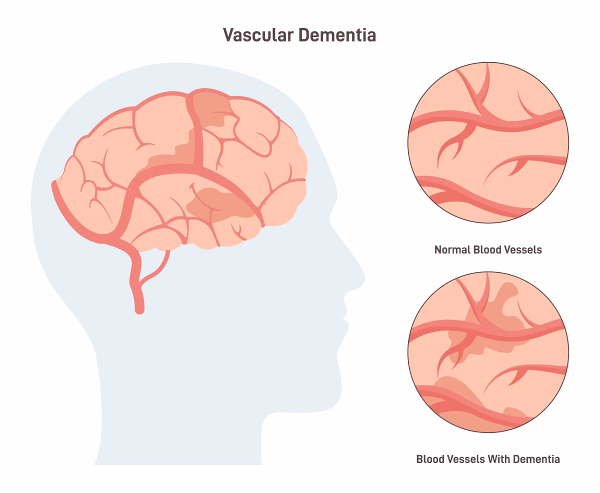 Is dementia associated with cognitive thinking?