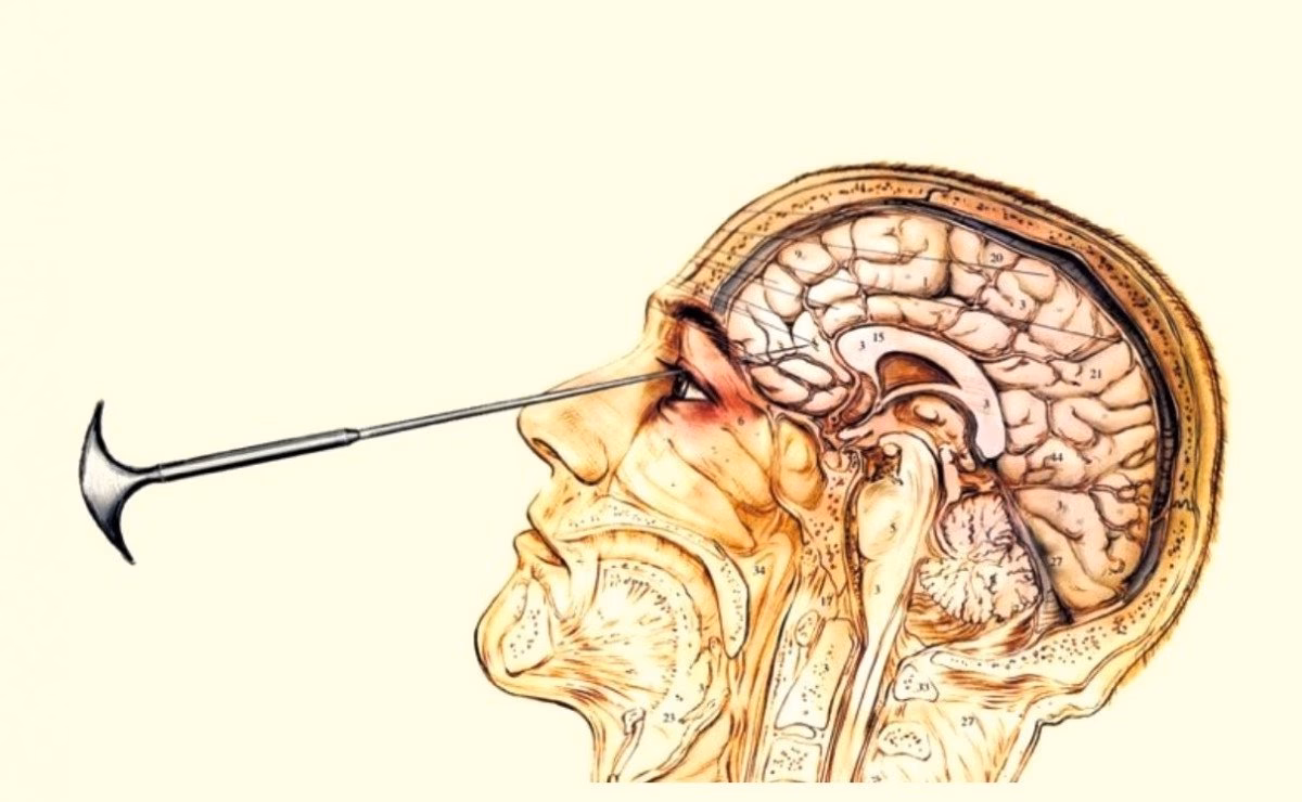 What is the Moniz lobotomy procedure?
