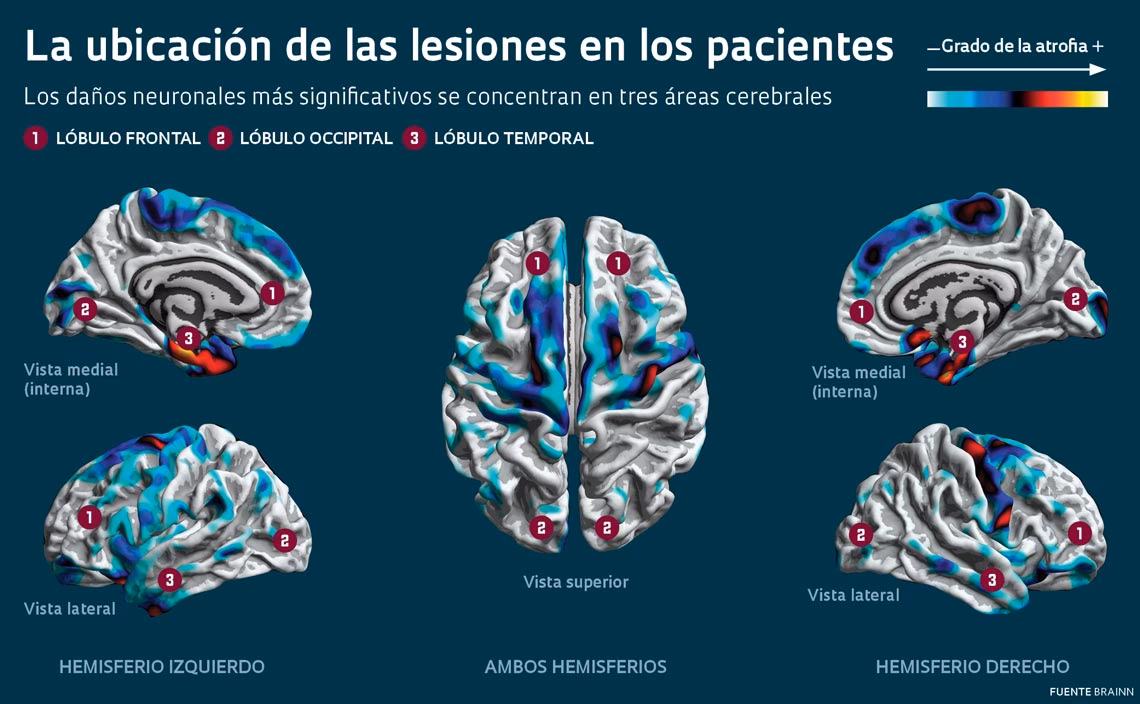 What are the symptoms of epilepsia?