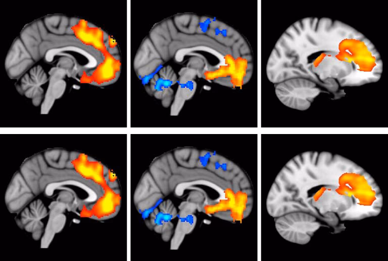 ¿Cómo afecta la esquizofrenia a la inteligencia?