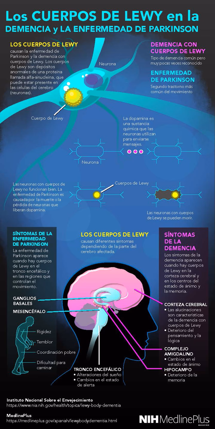 ¿Cuáles son los 4 criterios para la demencia por cuerpos de Lewy?