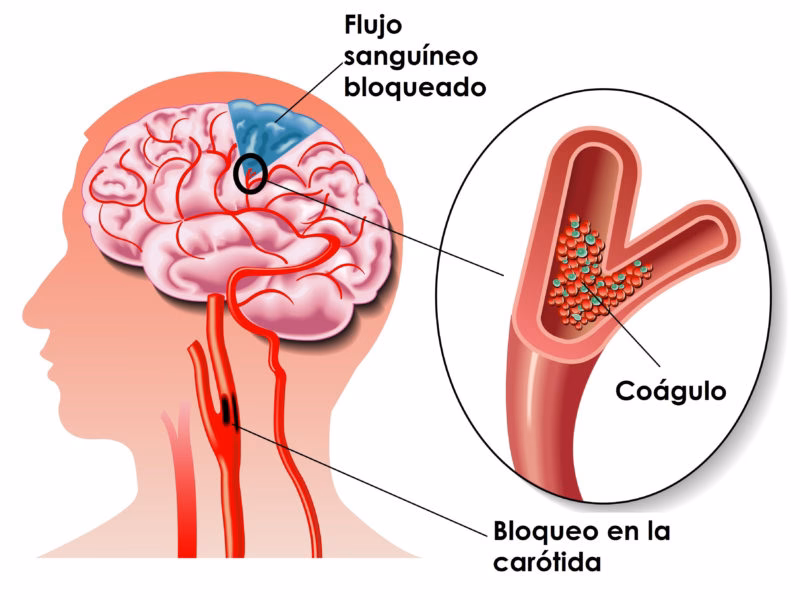 ¿Qué detona un infarto cerebral?