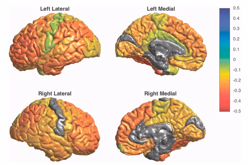 ¿Qué sustancia falta en el cerebro cuando hay bipolaridad?