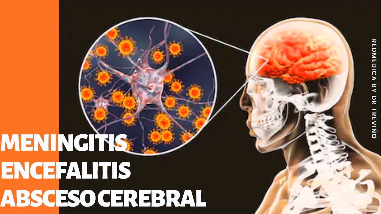 ¿Qué hace la meningitis al cerebro?