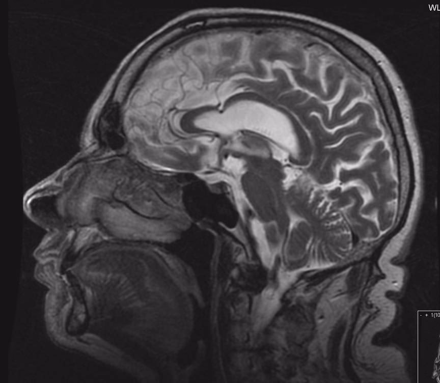What is the difference between MRI and MRI neurography?