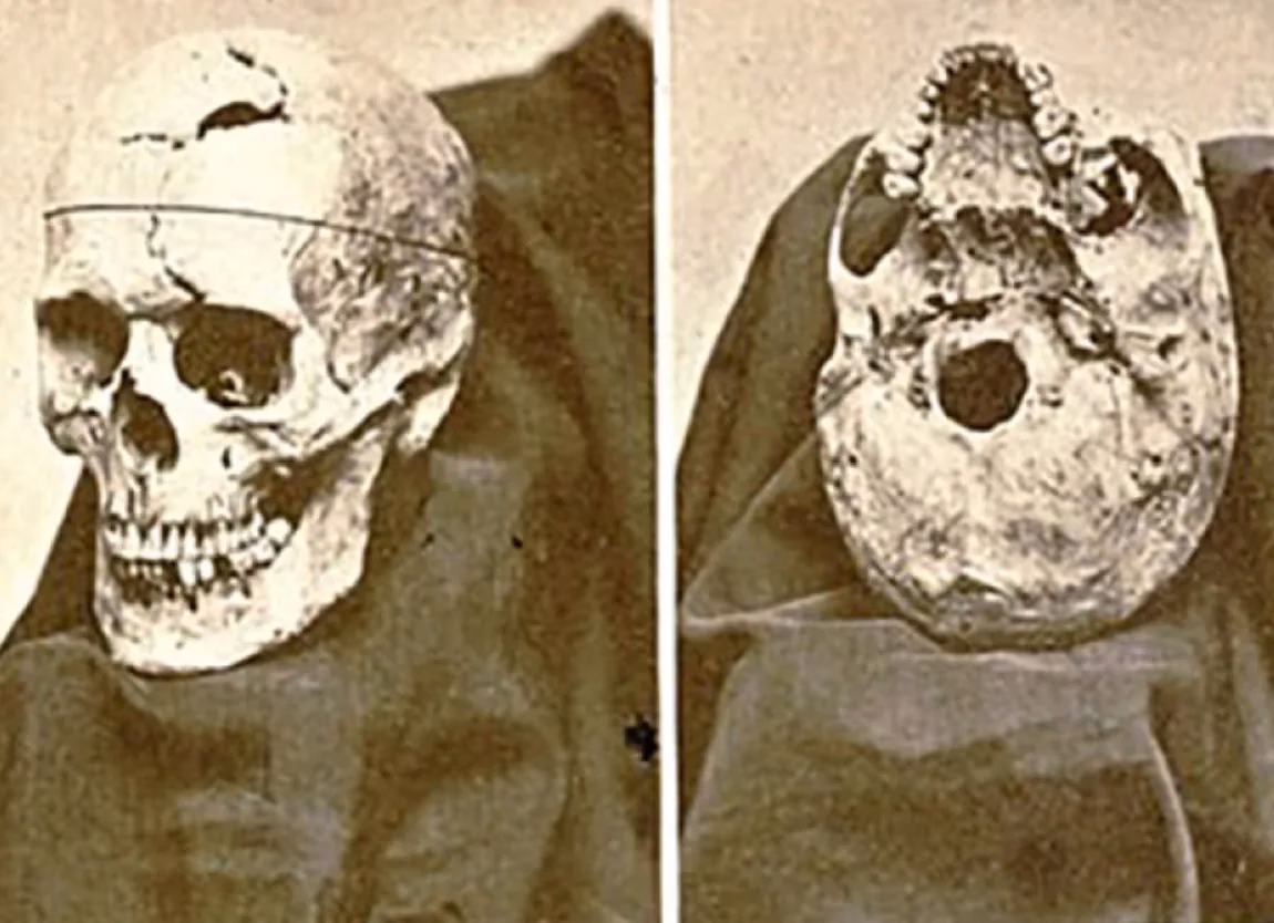 ¿Qué es el síndrome de Phineas Gage?