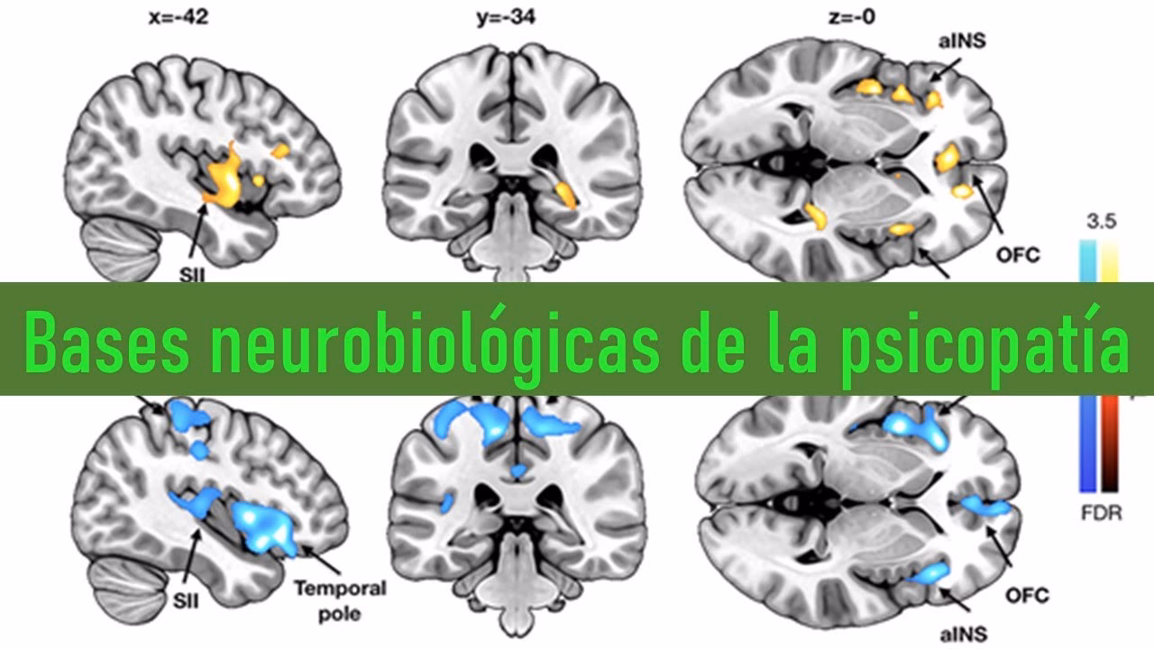 ¿Qué parte del cerebro tienen dañada los psicópatas?