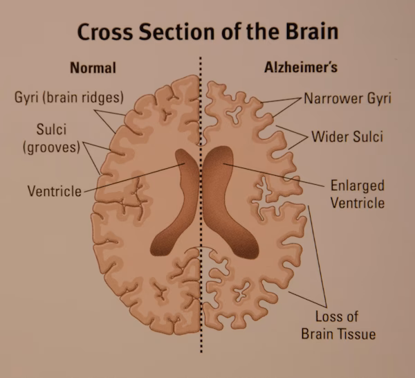 Which is a neurological hallmark of Alzheimer's disease?