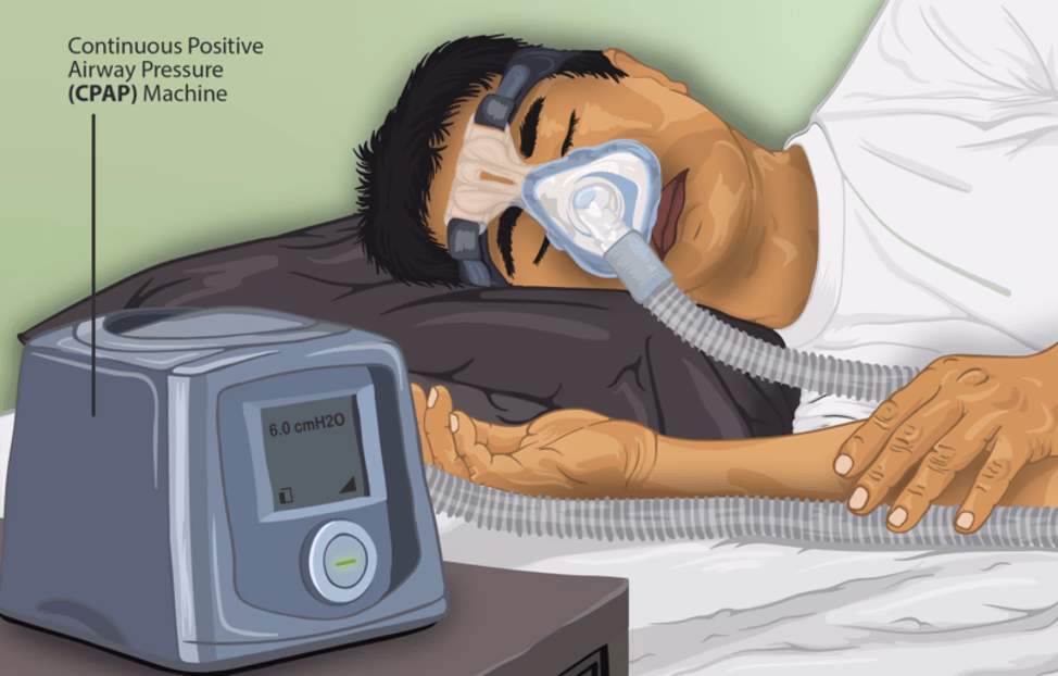 What does CPAP do for the brain?