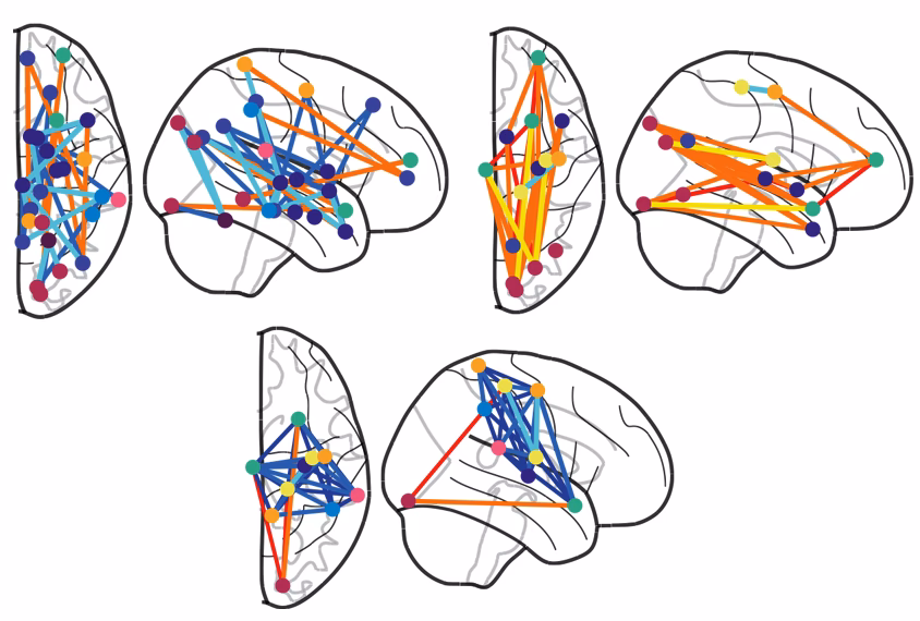 What is the new breakthrough in autism?