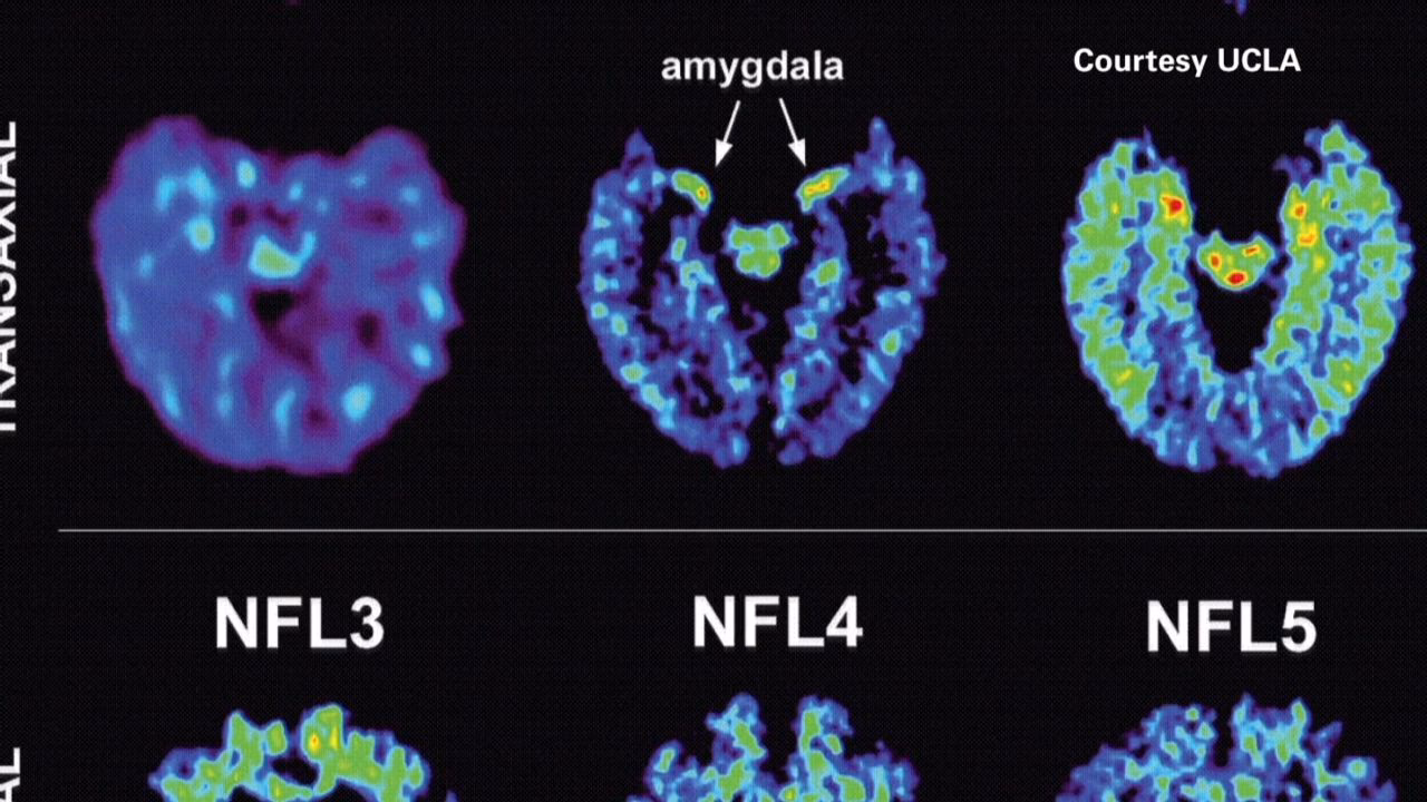 What is NfL a biomarker for?