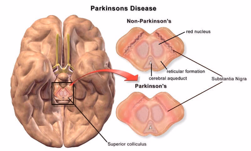 What is the neuroscience behind Parkinson's disease?