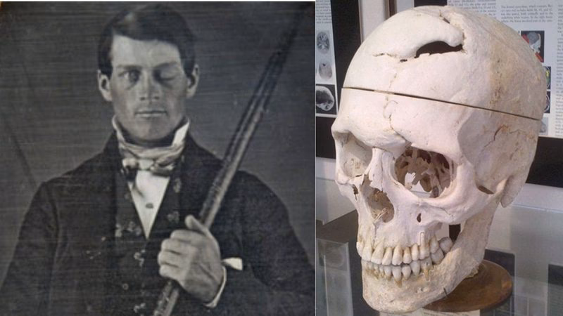 Who is the most famous patient in neuroscience?