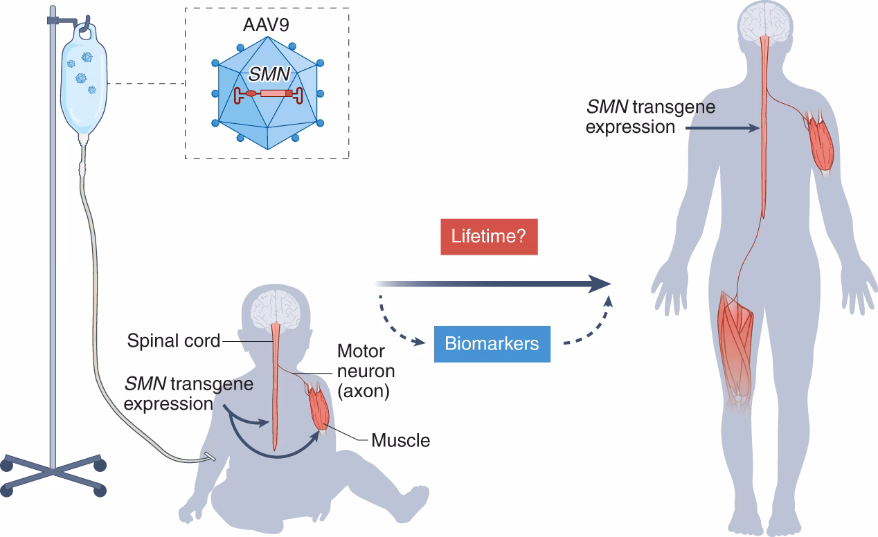 What is the SMA syndrome of the brain?