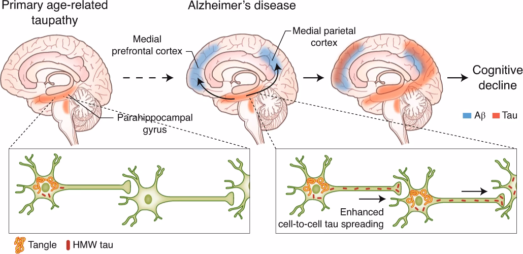 What neurological diseases are tau?
