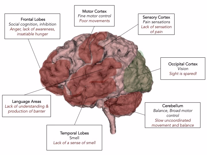 What parts of the brain are affected in zombies?